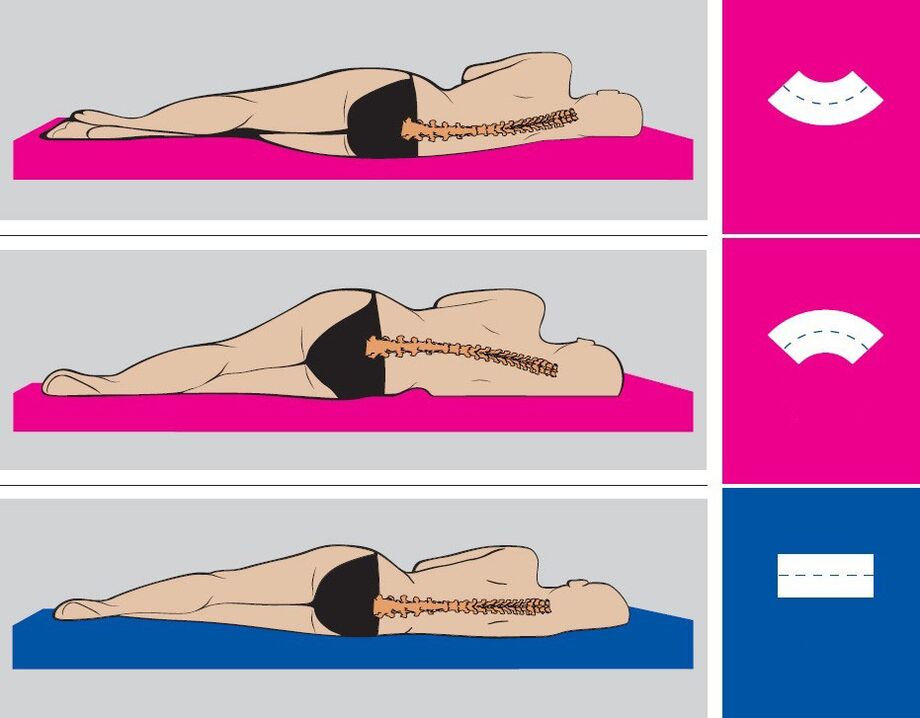 Postura correcta durante o sono para a osteocondrose lumbar