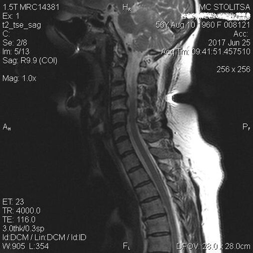 Osteocondrose e espondilose da columna cervical