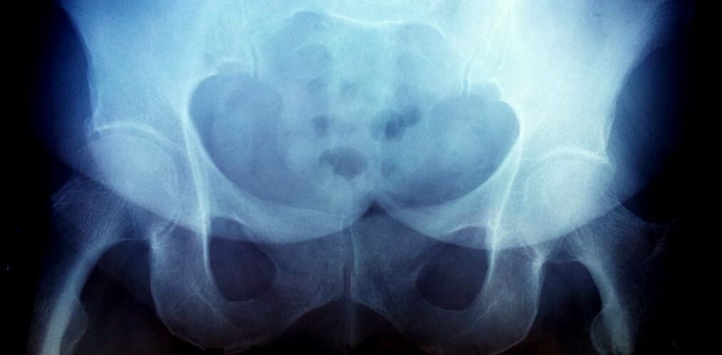 Imaxe x -ray con osteoartrite do 2º grao